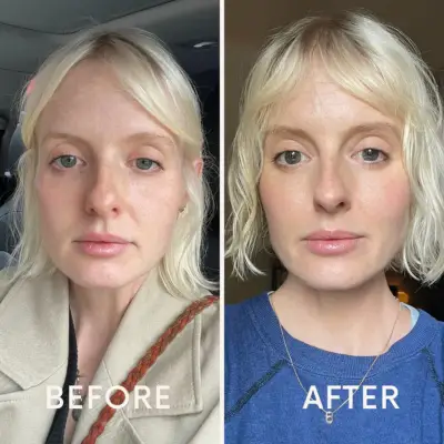 Sculptra before and after