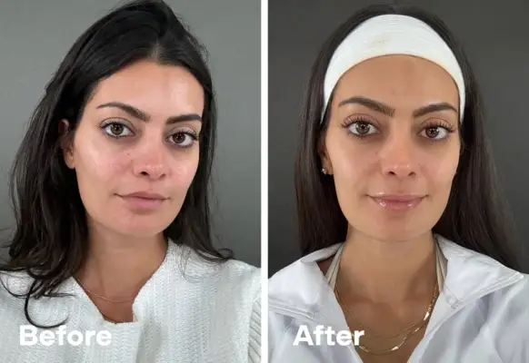 clearsilk laser before and after