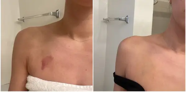 Best Concealer For Covering Hickeys