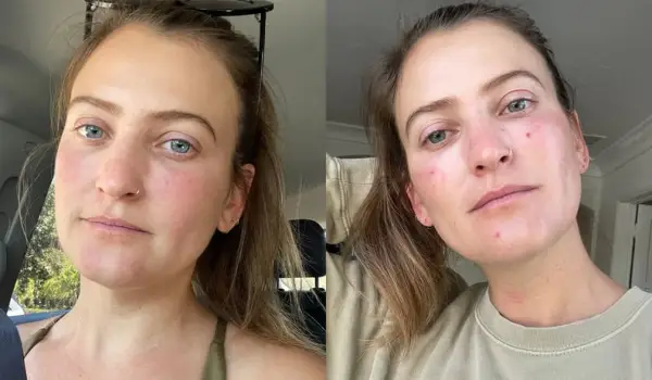 Immediately After and One Day Post-Laser