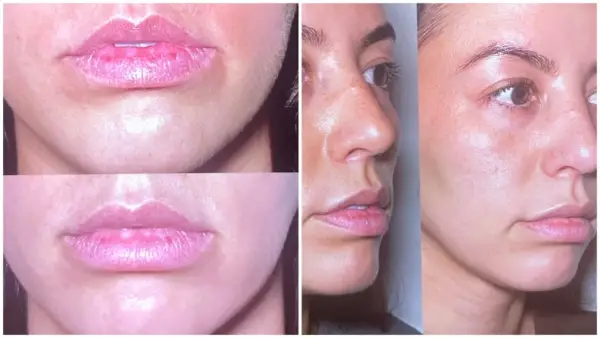 Lip Filler Dissolved Editor Experiment