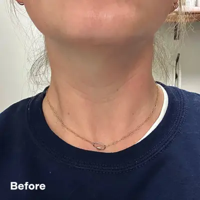 Neck Botox Editor Experiment
