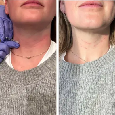 Neck Botox Editor Experiment