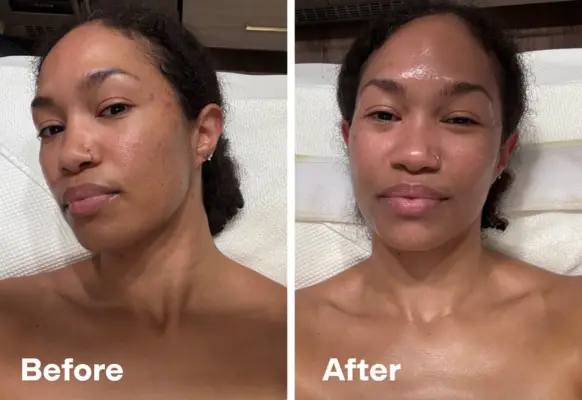 hydrafacial before and after 