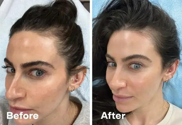 alma ted hair treatment review