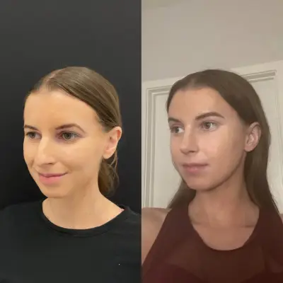 Courtesy of Dr. Kassir - 24 year old patient had a One Stitch Brow Lift