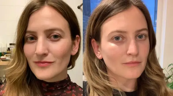 Undereye Filler Before and After: 10 Days After
