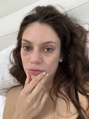 Residual bruising after brow lift surgery