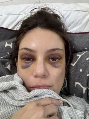 Brow lift surgery experience