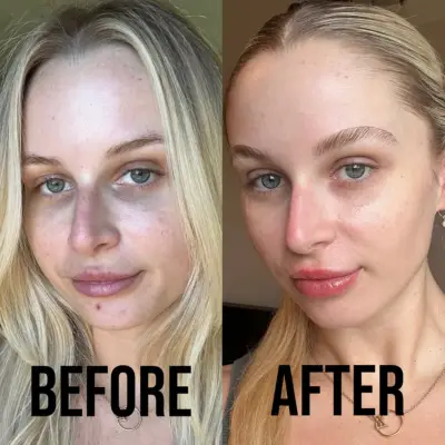 Taylor Before and After Using OLAY Super Serum